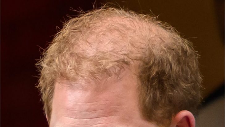 Is Prince Harry balding?