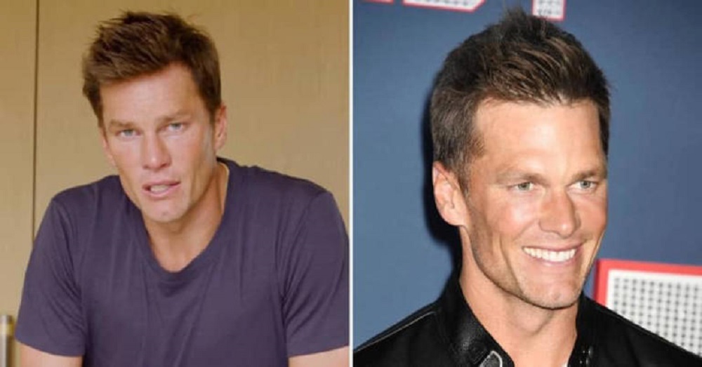 Tom Brady hair transplant rumors.